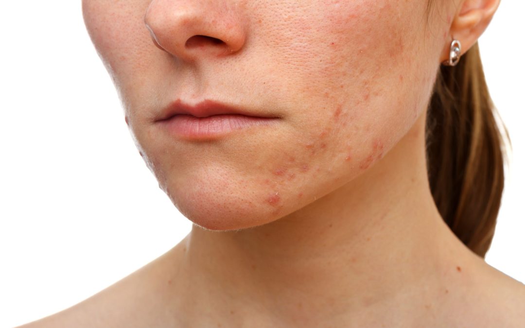 Achieve Flawless Skin with Hyperpigmentation Treatment Cancun MX