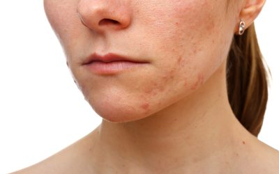 Achieve Flawless Skin with Hyperpigmentation Treatment Cancun MX