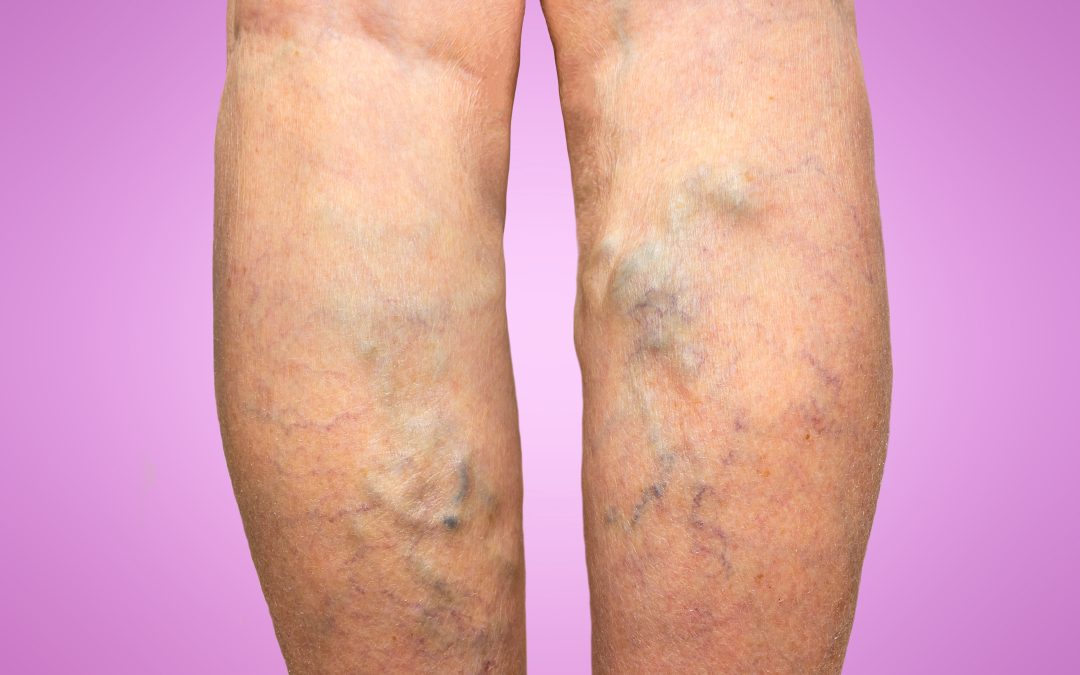 Regain Comfort with a Vein Specialist in Petersburg, VA, for Effective Varicose Vein Treatment
