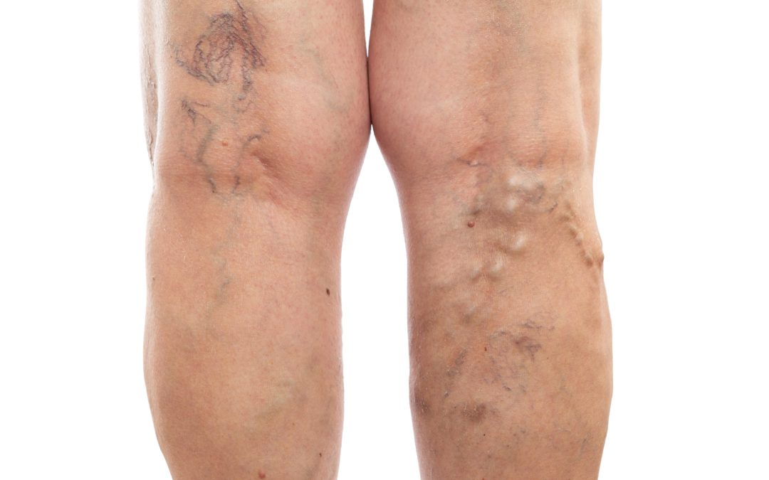 Say Goodbye to Leg Discomfort with Spider Veins Treatment in Virginia Beach, VA