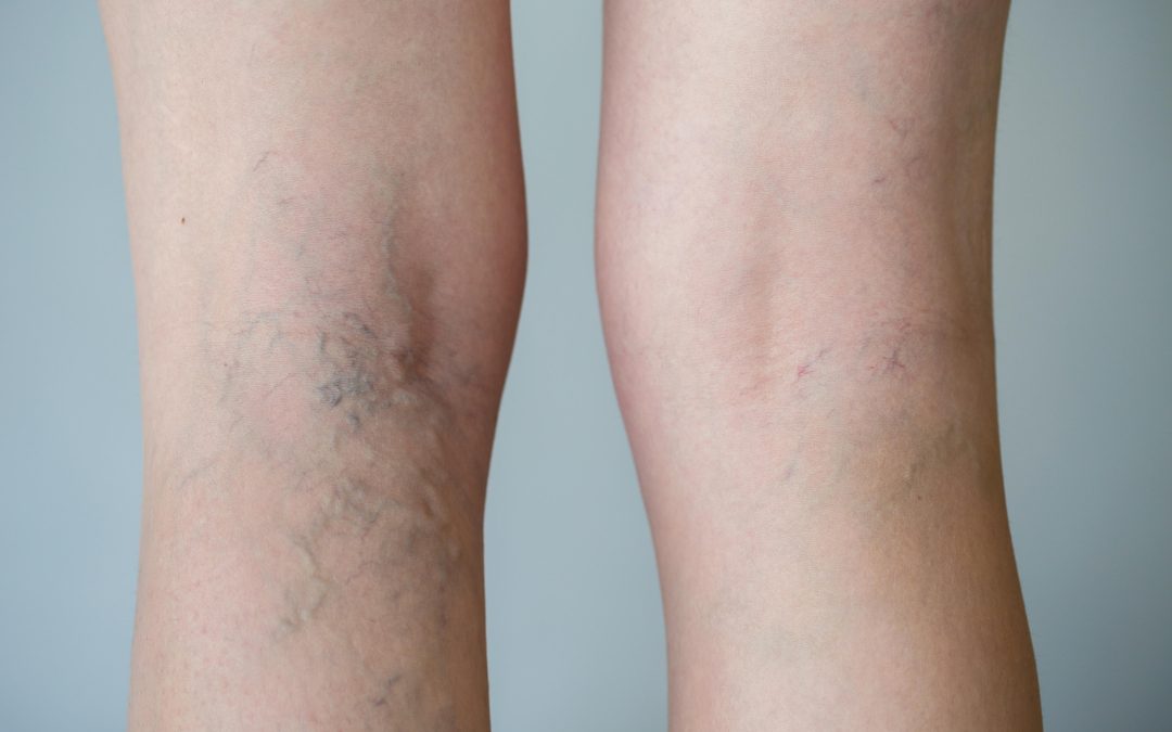 Improve your mobility and confidence through varicose veins treatment in Warrenton, VA